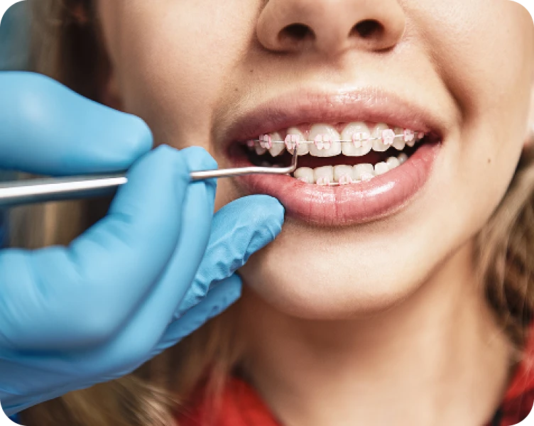 Appareils dentaires céramiques