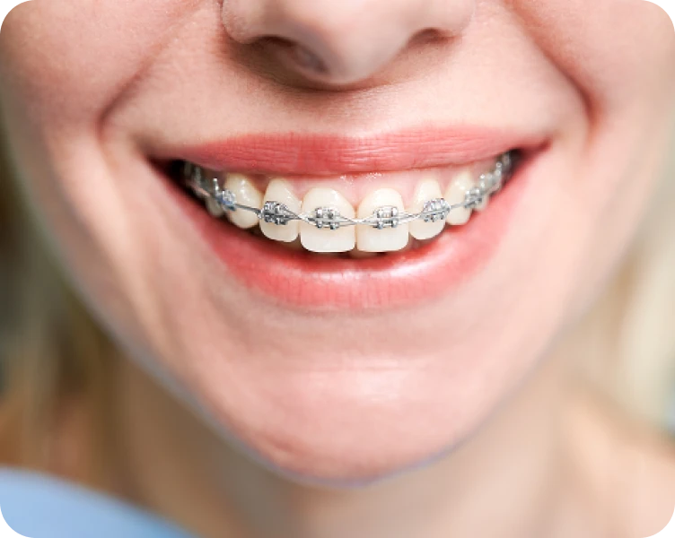 Appareils dentaires métalliques